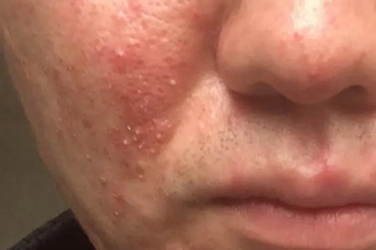 糖皮质激素依赖性皮炎脓包图