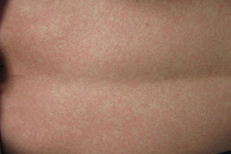 典型麻疹出疹期背部红点图