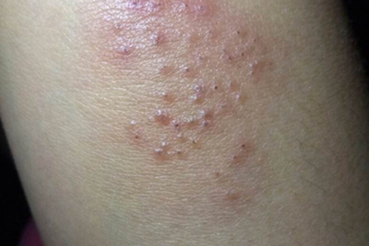 铜绿假单胞菌毛囊炎小疙瘩图