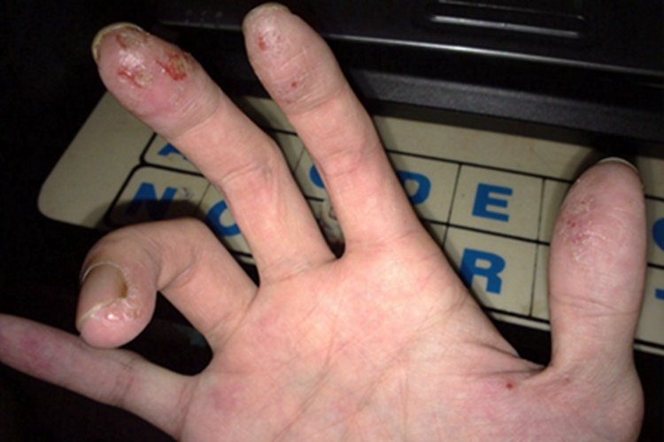 自体敏感性湿疹裂纹图