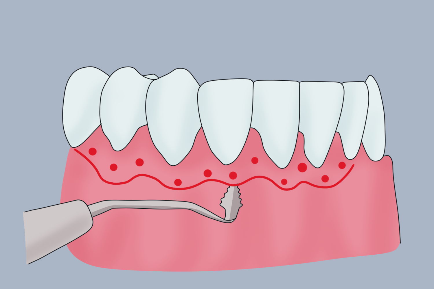 进行第二切口图