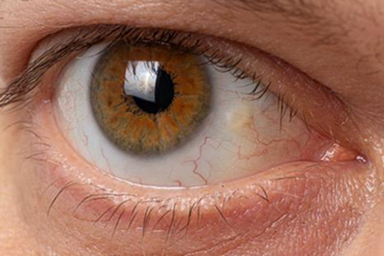 睑裂斑眼球有斑图
