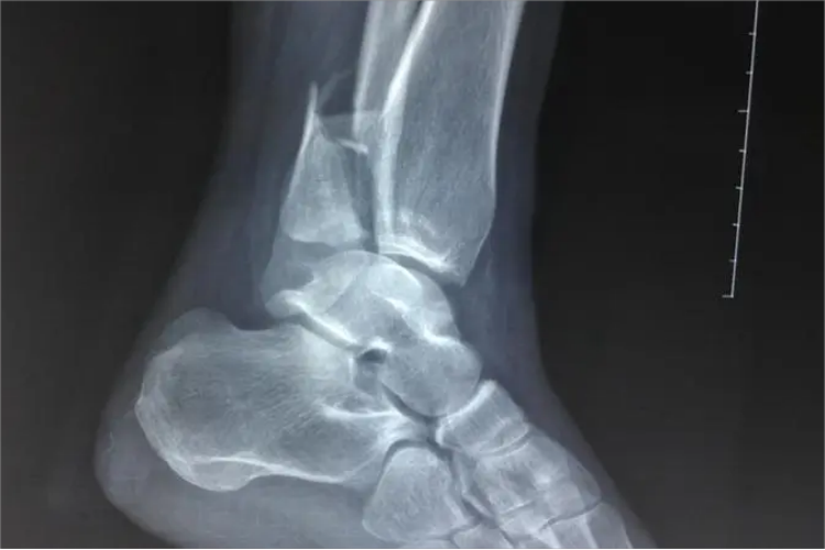 脚踝骨折片子图