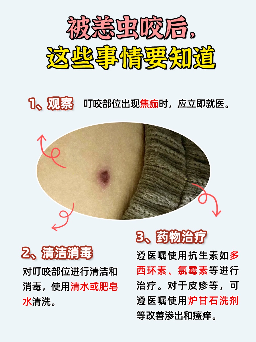 恙虫咬人后，这些症状要警惕！