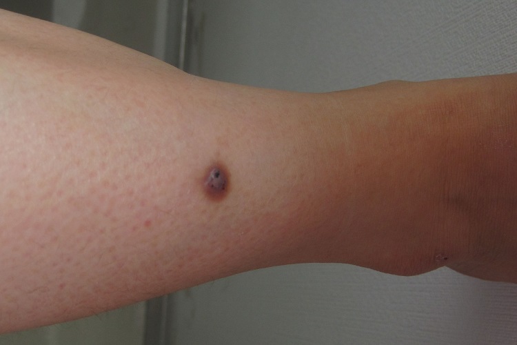 结节型黑色素瘤小腿症状图