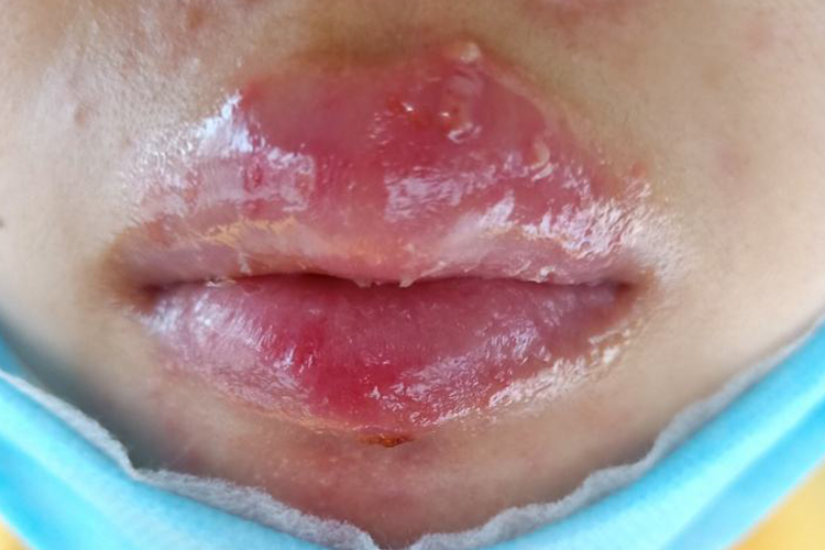 唇部发亮坏死图