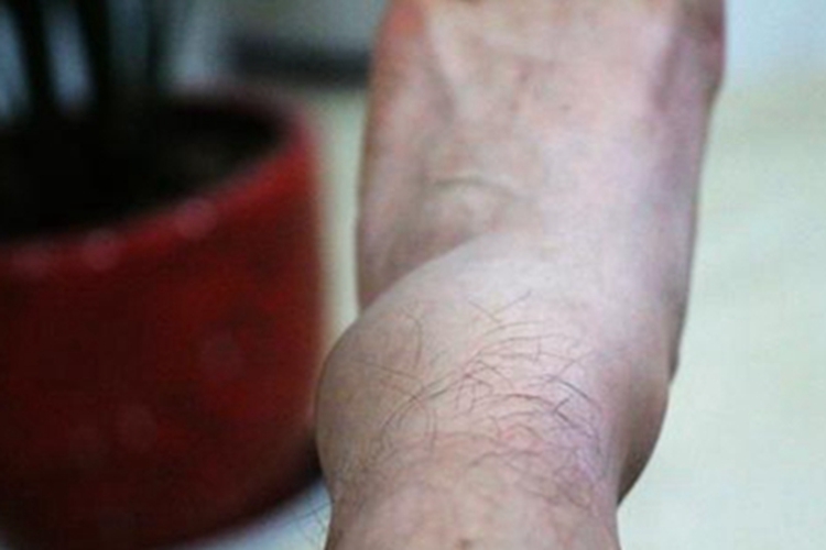 踝扭伤脚踝水肿图