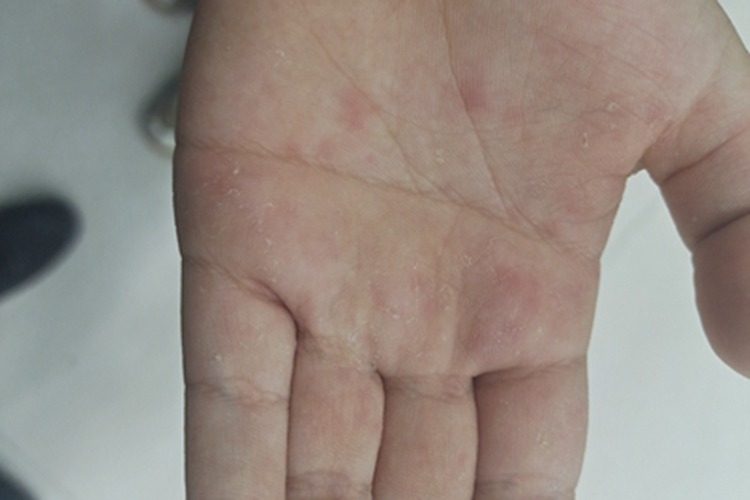 急性湿疹手掌有红色斑块图 急性湿疹手掌有红色斑块图