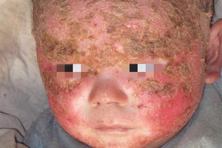 湿疹面部皲裂图