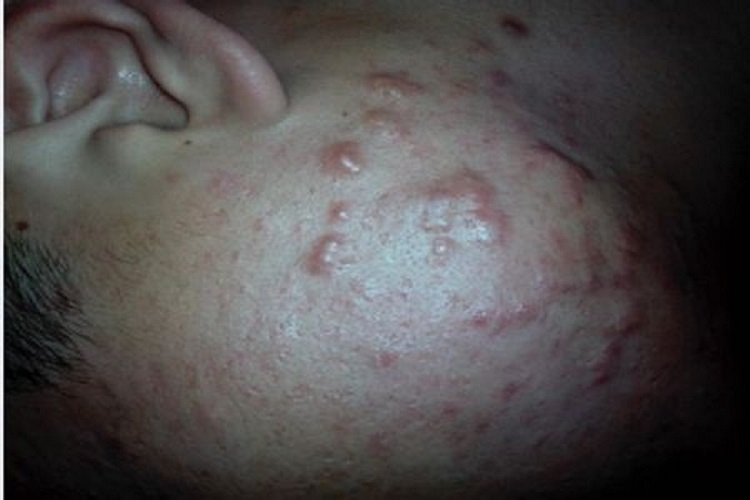 增生性痘印图 增生性痘印图