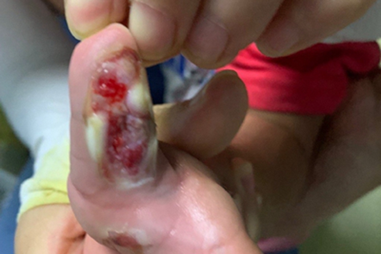 电烧伤手指糜烂缺损图 电烧伤手指糜烂缺损图