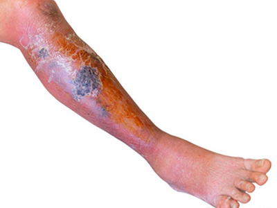 急性网状淋巴管炎的症状和图片 - 有来医生