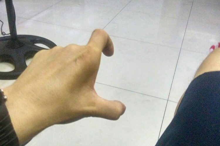 尺神经损伤虎口凹陷图