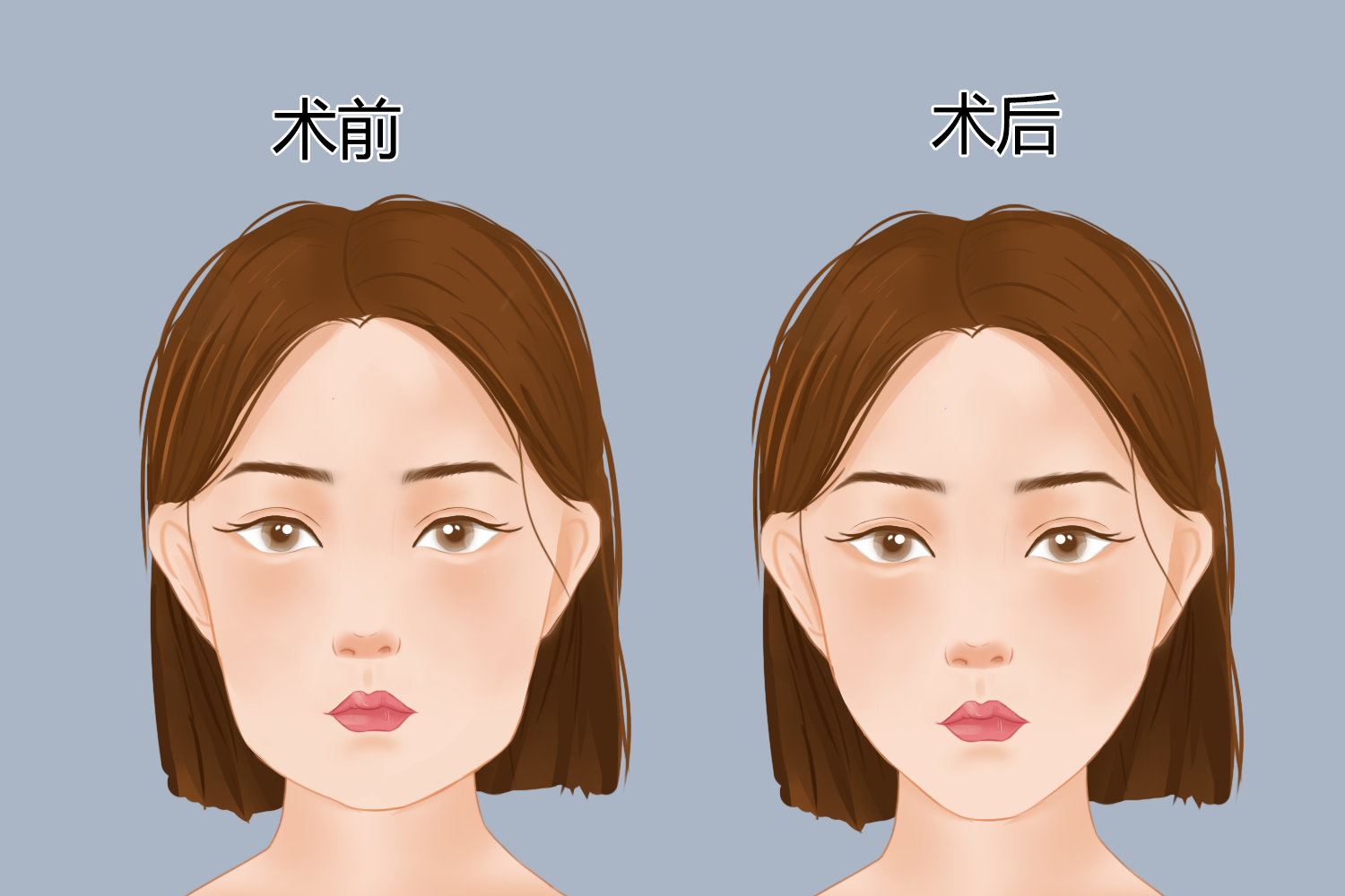 下颌角肥大手术对比图
