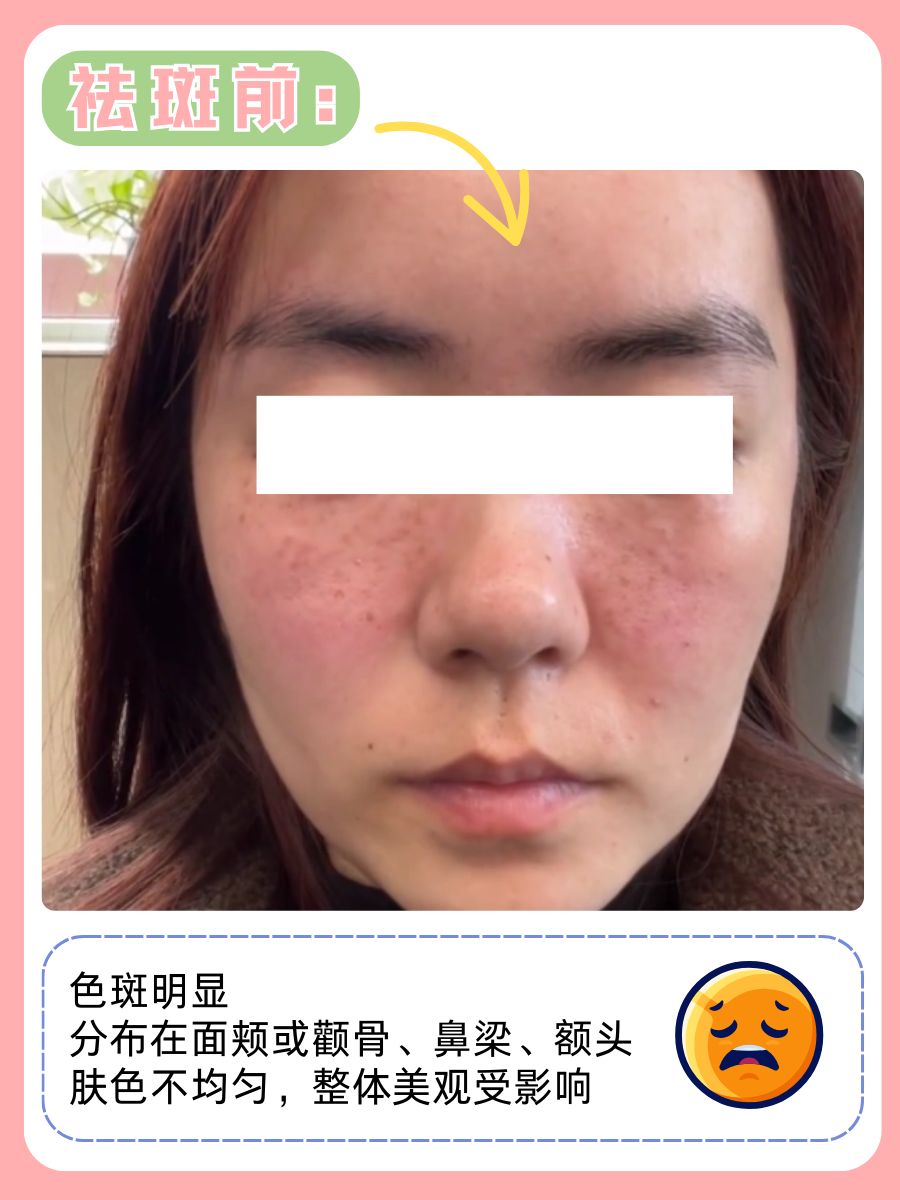 祛斑的前后效果图对比！附面部护理大全