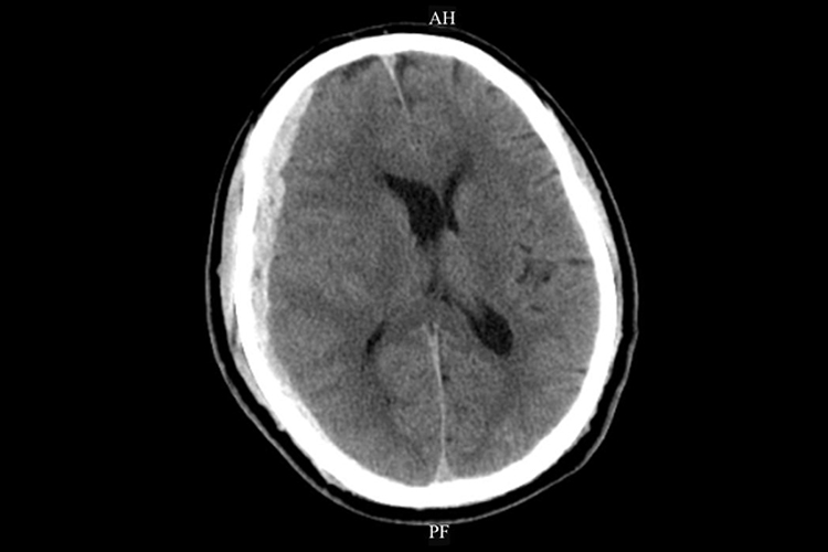 急性硬膜下血肿ct图