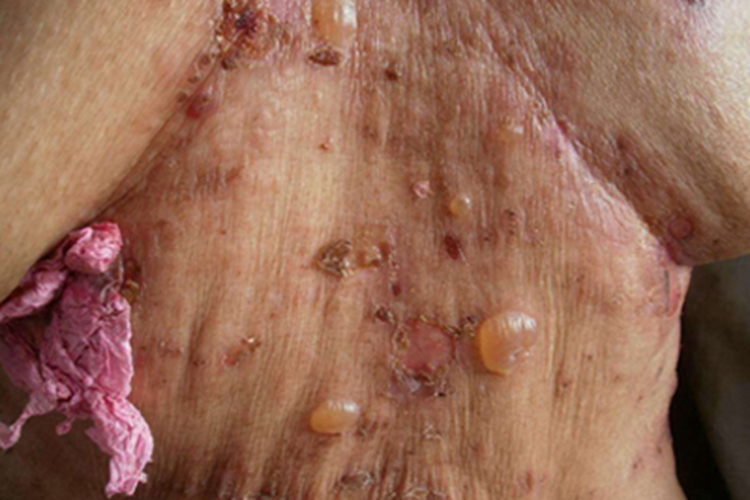 落叶型天疱疮腹部症状图