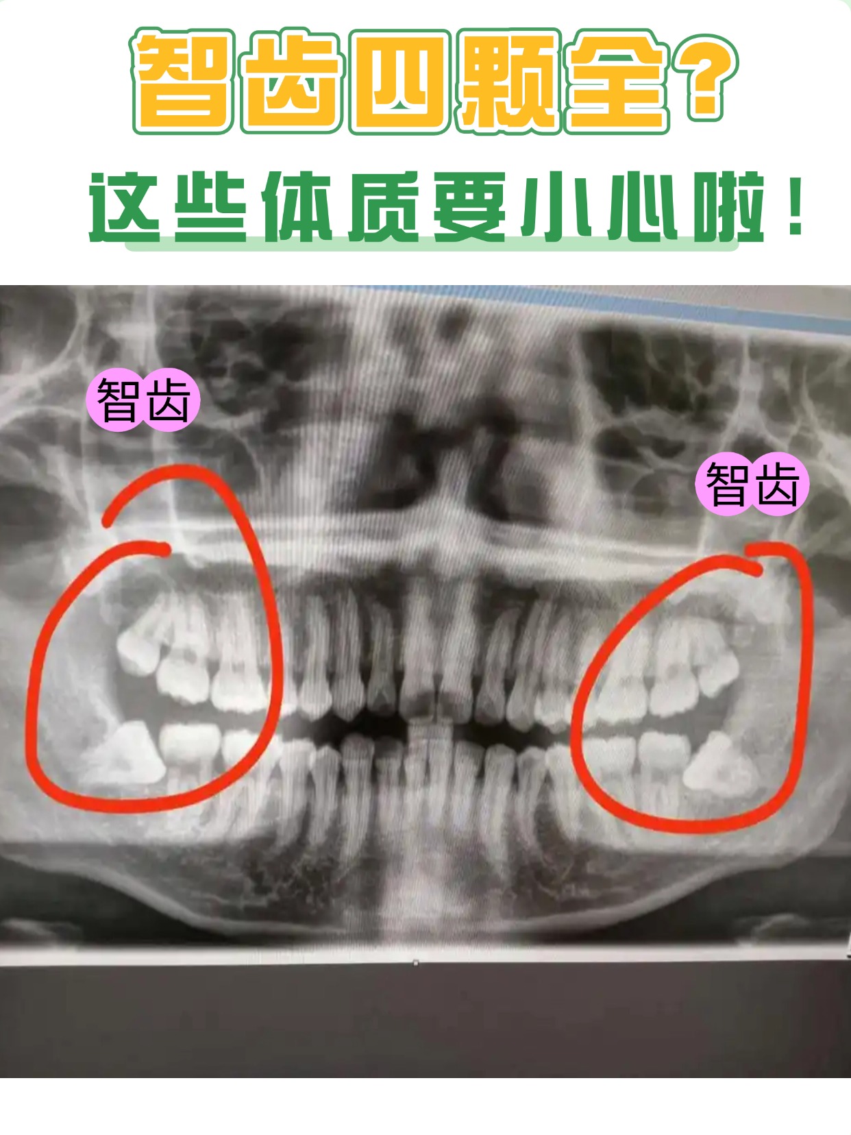 智齿四颗全?这些体质要小心啦!