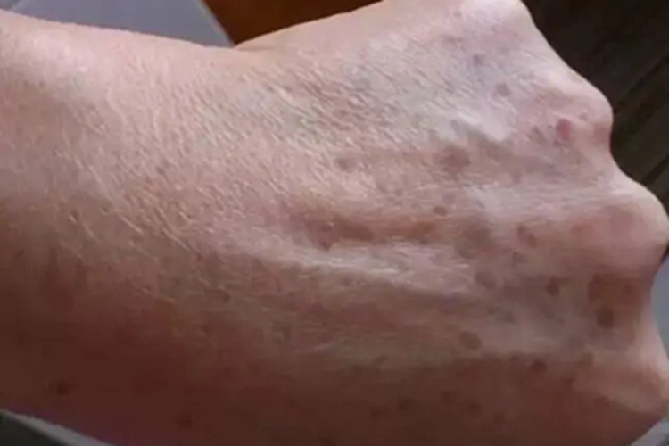 雀斑手背症状图 雀斑手背症状图