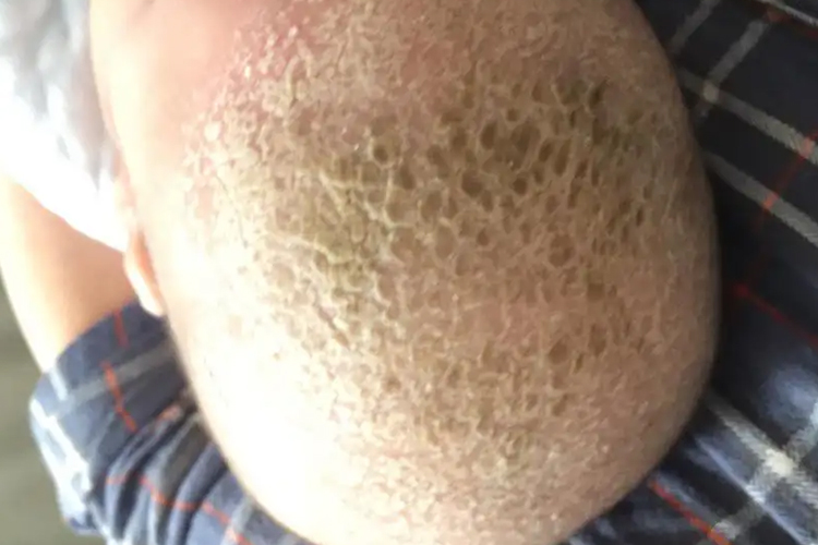 宝宝头上胎垢图