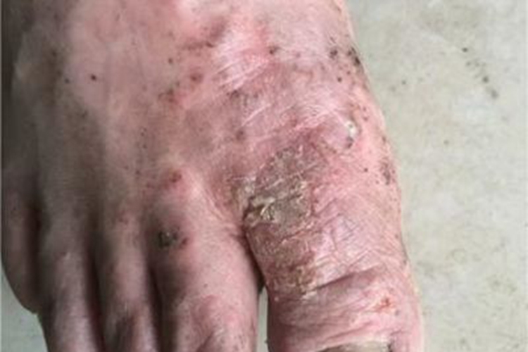 水疱型足癣脚背结痂脱皮图