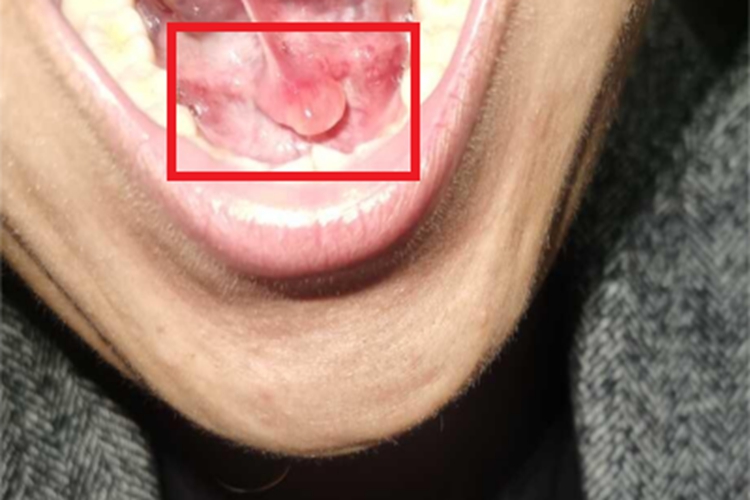 涎腺囊肿口腔囊肿图 涎腺囊肿口腔囊肿图