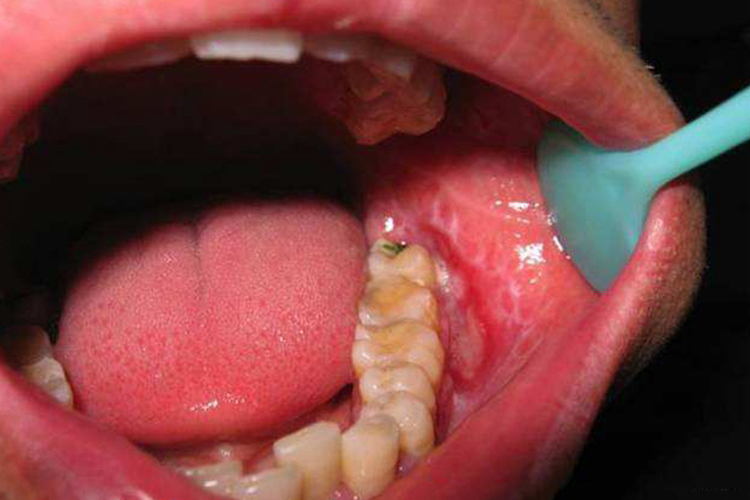 放疗化疗性口腔黏膜炎水肿图