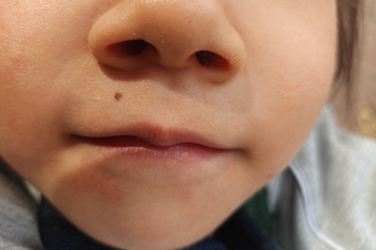 交界痣口周有褐色斑块图