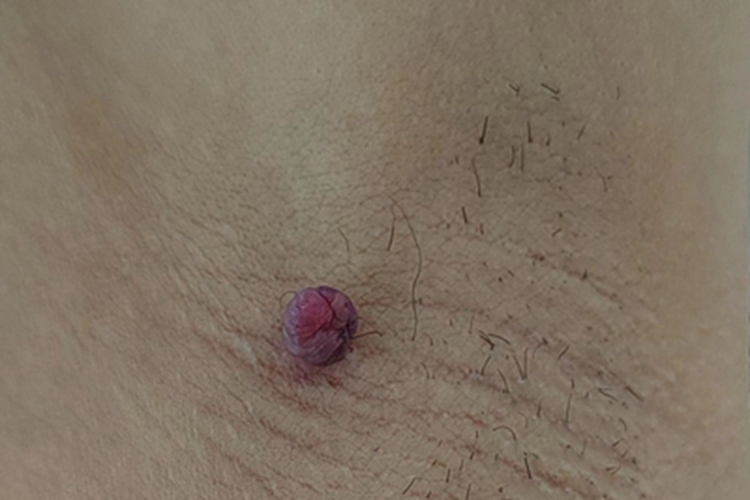 皮肤纤维瘤腋下有肉瘤图