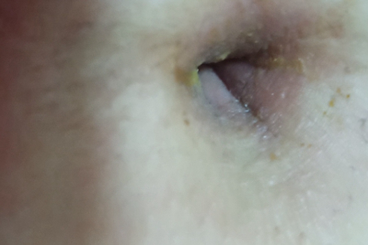 脐炎肚脐里流水结黄痂图