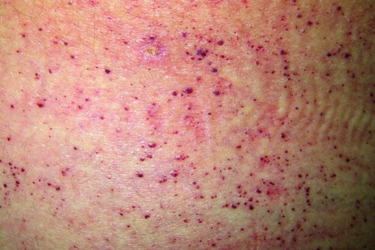 弥漫性躯体性血管角化瘤结节图 弥漫性躯体性血管角化瘤结节图