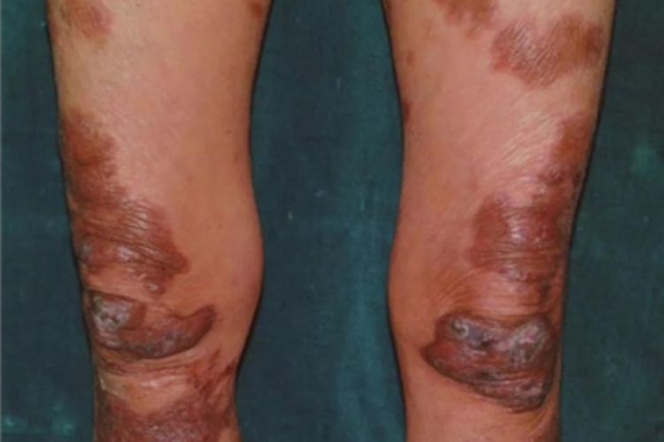 持久性隆起性红斑大腿症状图