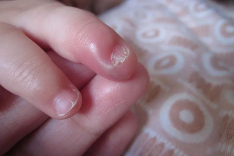 甲沟炎导致指甲变形图