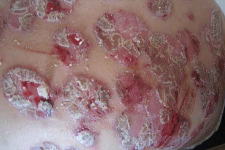 艾滋病银屑病样皮损图