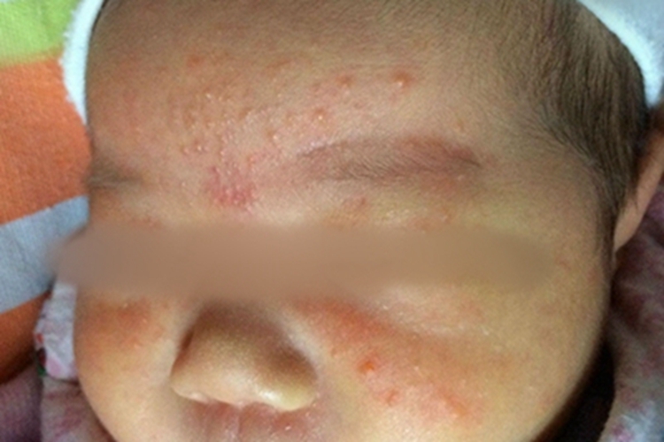 自体敏感性湿疹丘疹图