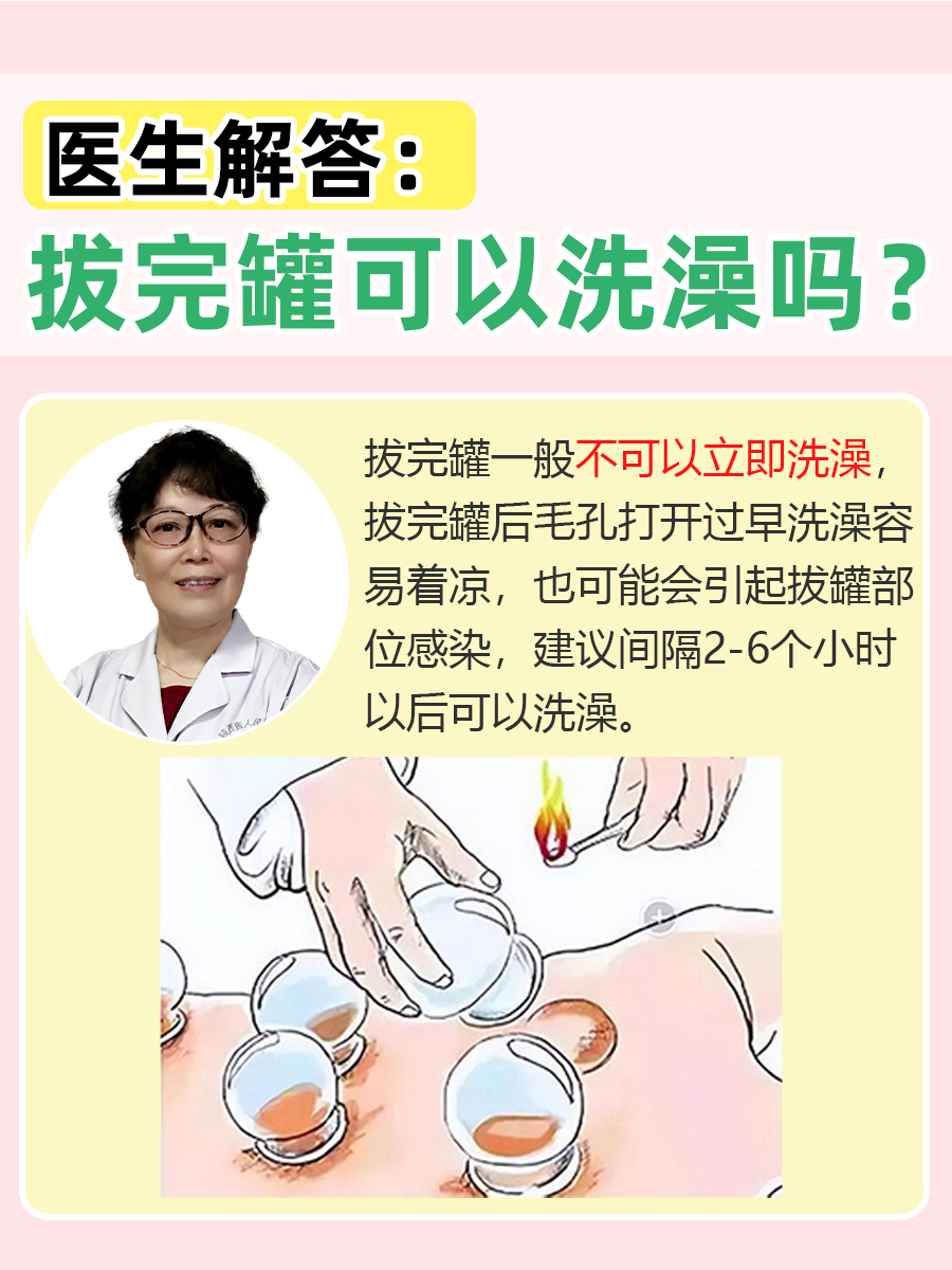 医生解答：拔完罐可以洗澡吗？