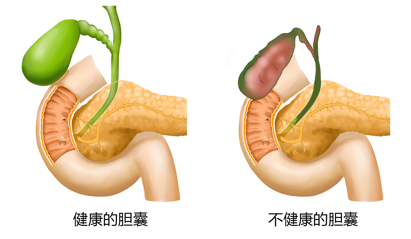 胆囊对比图