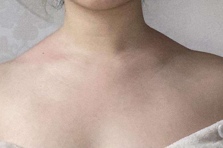 女生斜方肌太厚图 女生斜方肌太厚图