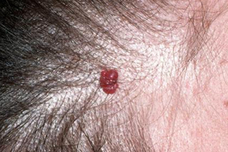 樱桃状血管瘤症状图 樱桃状血管瘤症状图