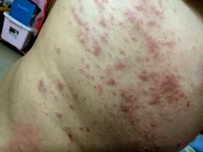 急性湿疹腰上长了一片红疹图.png
