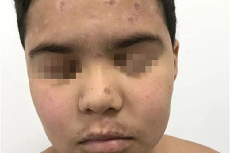 儿童期特应性皮炎面部斑图