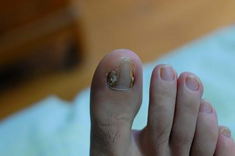 大脚趾慢性甲沟炎图