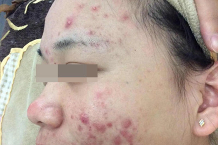 痤疮面部几个红色的疙瘩图