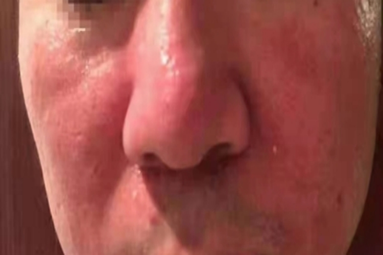 面部皮炎脸部潮红图