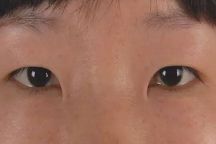 内眦赘皮内眼角像月亮图