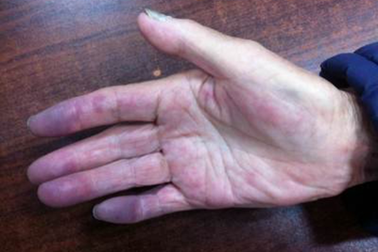 雷诺氏综合征手指青紫图