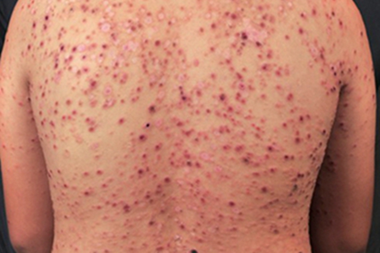 急性痘疮样苔藓样糠疹背部结痂图