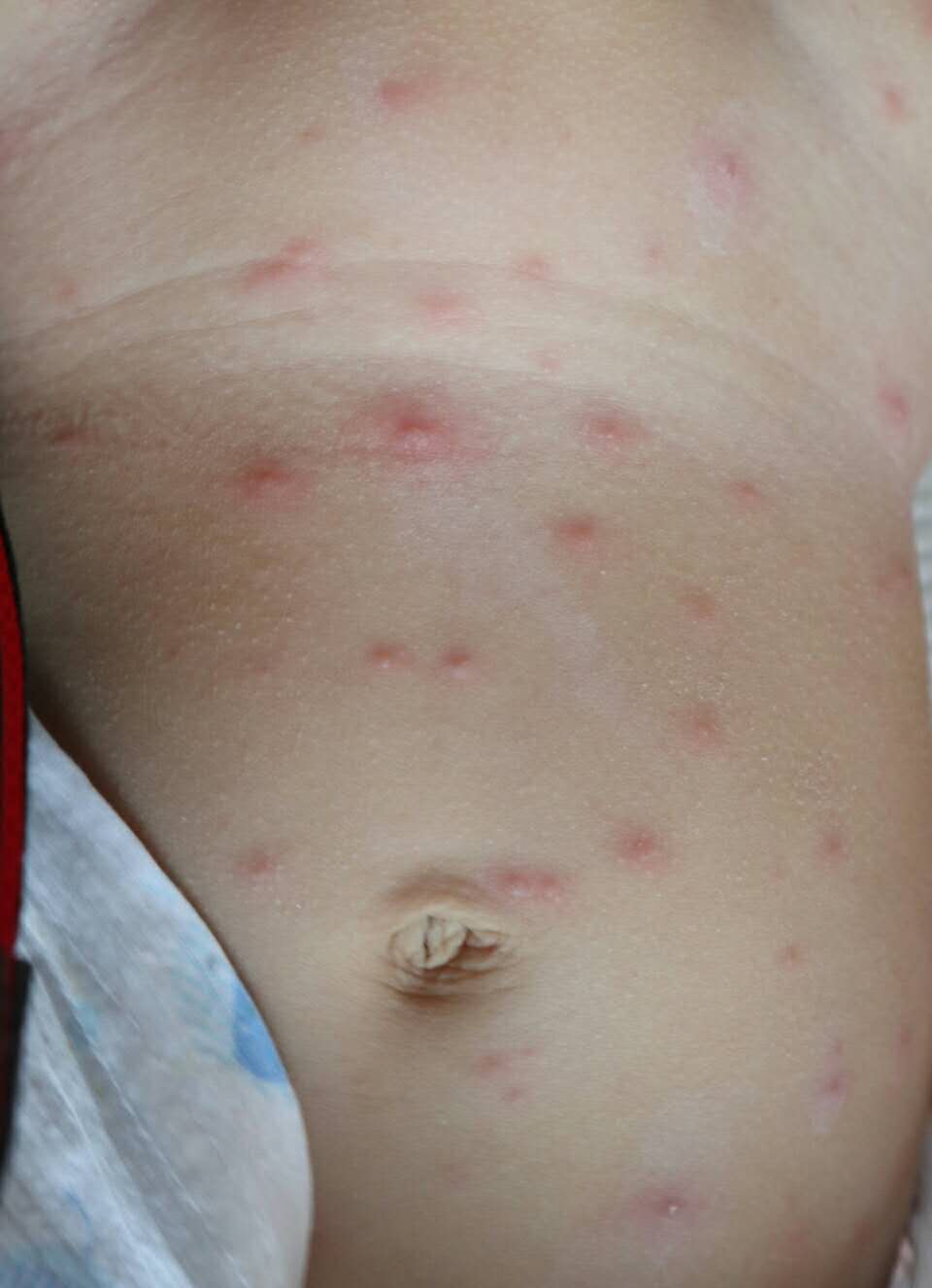 春季传染病水痘图片图片