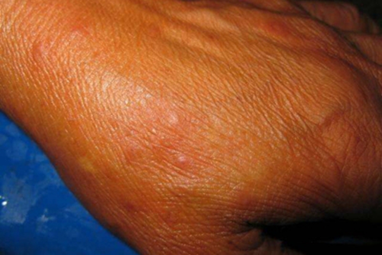 尾蚴性皮炎手背有疙瘩图 尾蚴性皮炎手背有疙瘩图