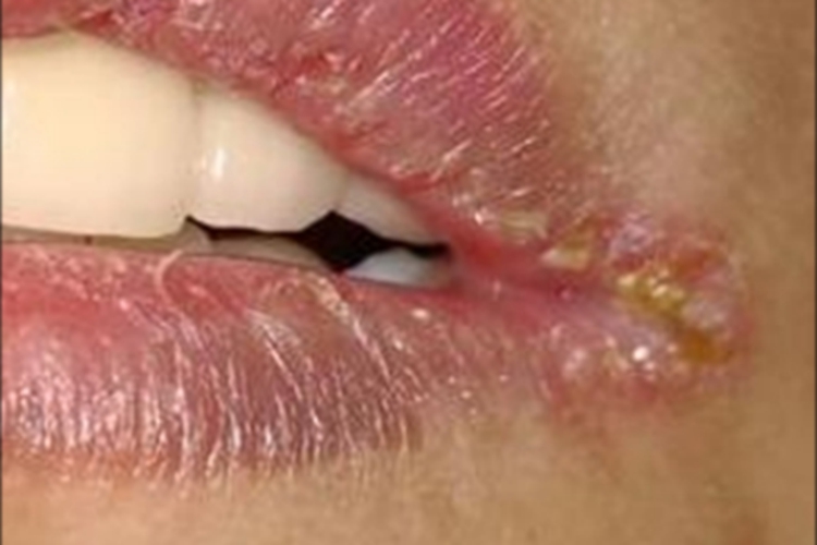 念珠菌性口角炎嘴唇症状图 念珠菌性口角炎嘴唇症状图